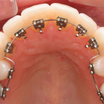 Dental Braces Treatment in Delhi NCR  Orthodontic Treatment Wires and  Braces Delhi