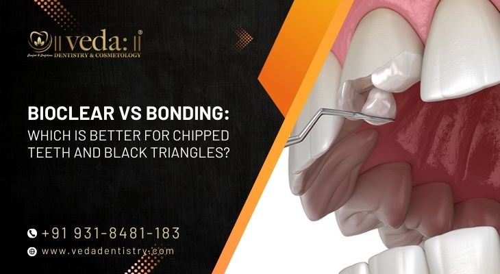 Bioclear vs Bonding: Which Is Better for Chipped Teeth and Black Triangles?