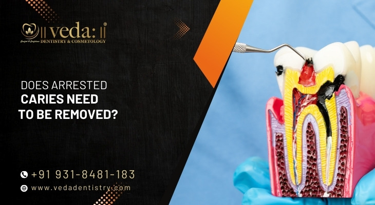 Does Arrested Caries Need To Be Removed?