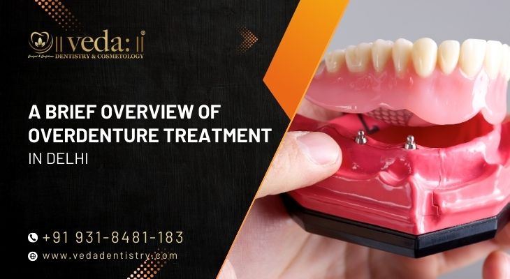 Overdenture Treatment In Delhi