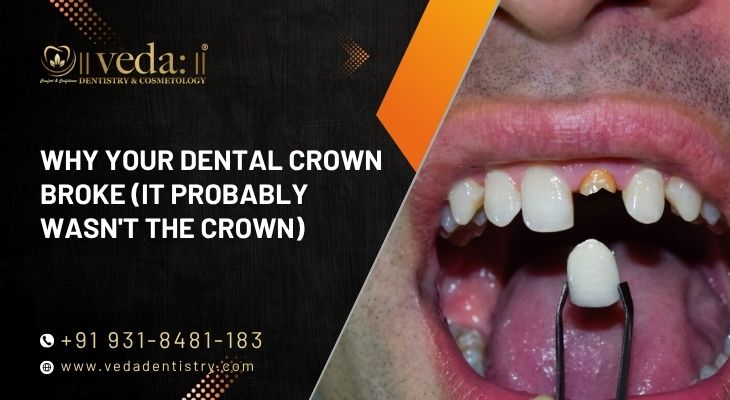 Why Your Dental Crown Broke (It Probably Wasn't the Crown)