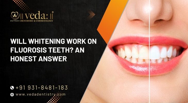 Will Whitening Work On Fluorosis Teeth? An Honest Answer