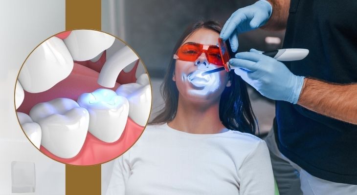 Tooth-Colored Fillings