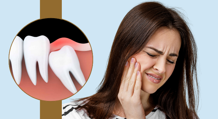 Wisdom Tooth pain treatment