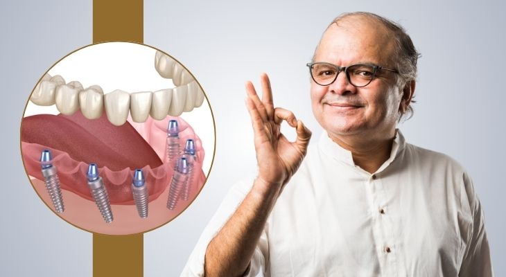 All-on-6 and All-on-8 Dental Implants in East Delhi