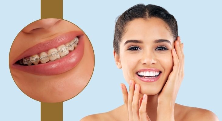 Damon Clear Braces in Delhi