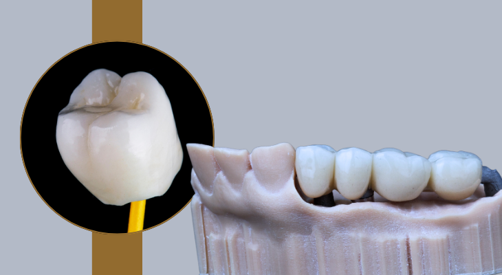 Dental Crowns and Bridges Treatment