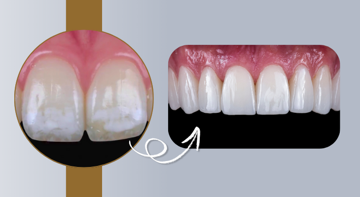 Dental Fluorosis Treatment