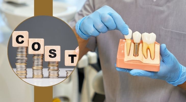 Dental Implants Cost in India