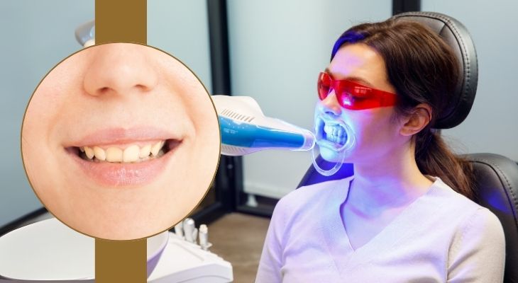 Discolored Teeth Treatment in Delhi