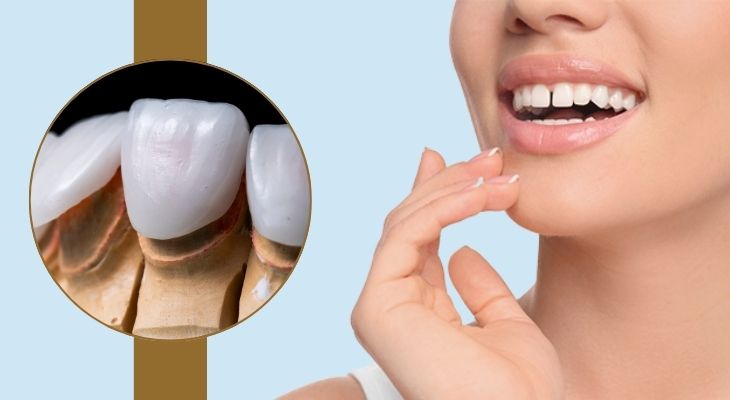 Gap Teeth Treatment in Delhi