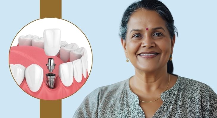 Immediate Dental Implants in Delhi 