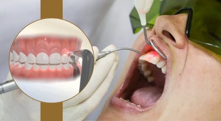 Laser Gummy Smile Treatment in Delhi, India