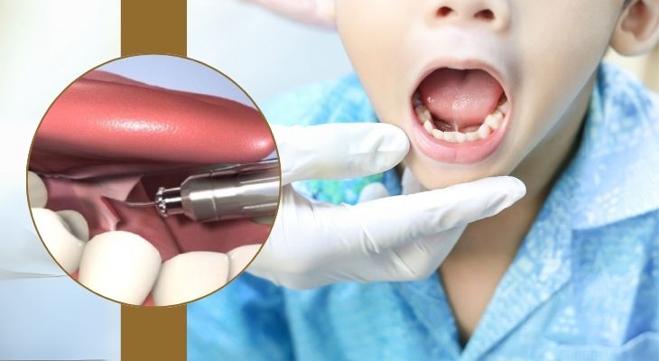 Laser Tongue Correction: Frenectomy Gum Surgery in Delhi 