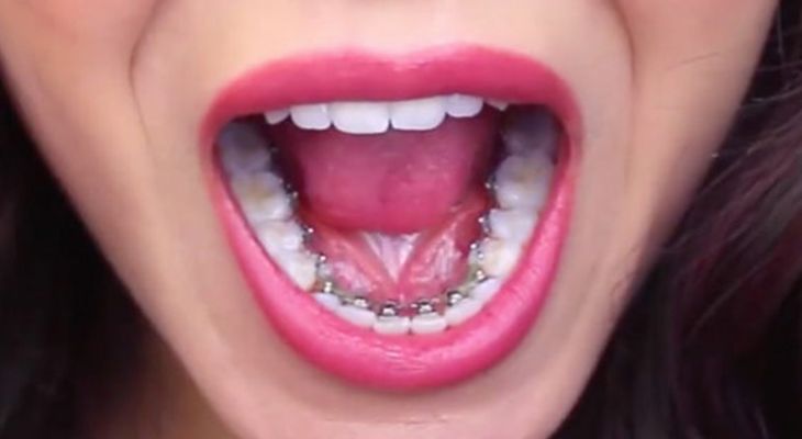 Lingual Braces: How it Works, Cost, Before and After Images