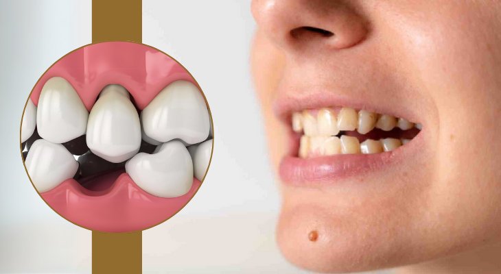 Loose Teeth Treatment