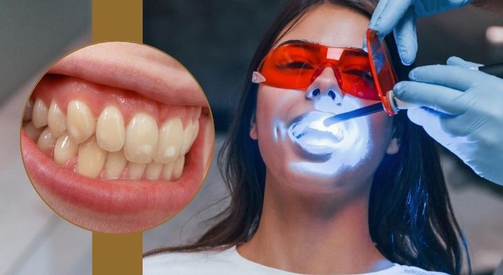 Mottled Teeth Treatment in Delhi 