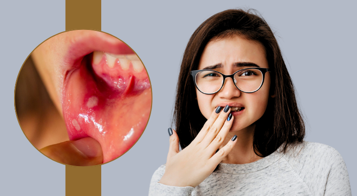 Mouth Sores Treatment