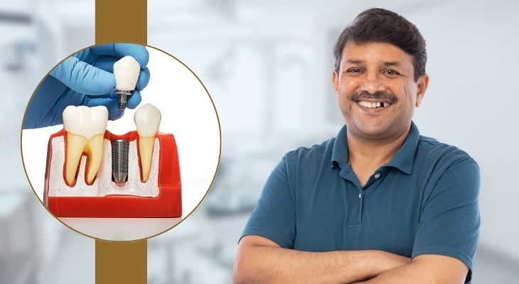 Single Tooth Implant in - Delhi