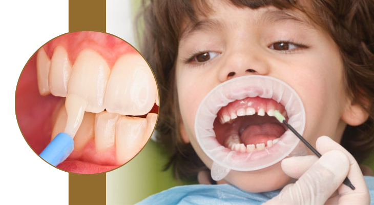 Teeth Fluoride Treatment