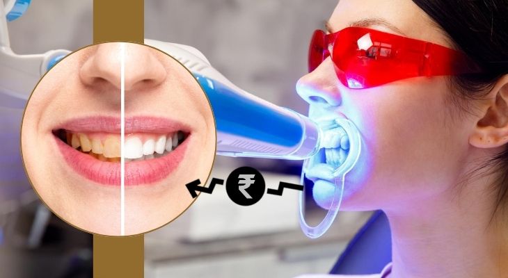 Teeth Whitening Cost in Delhi