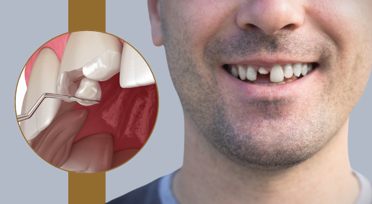 Best Tooth Fracture Treatment 