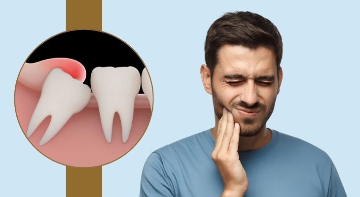 Wisdom Tooth Extraction in Delhi