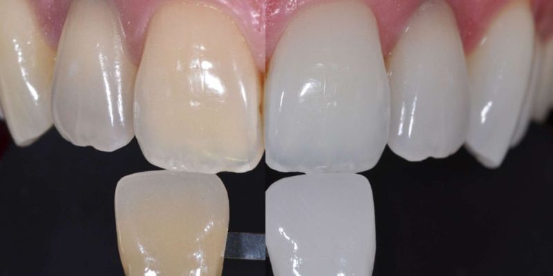 dental fluorosis treatment in indirapuram delhi