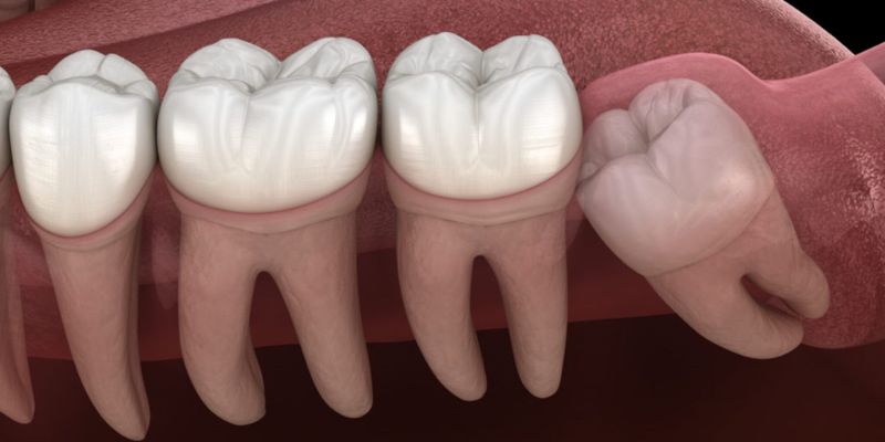 Get painfree wisdom tooth removal treatment in East Delhi.